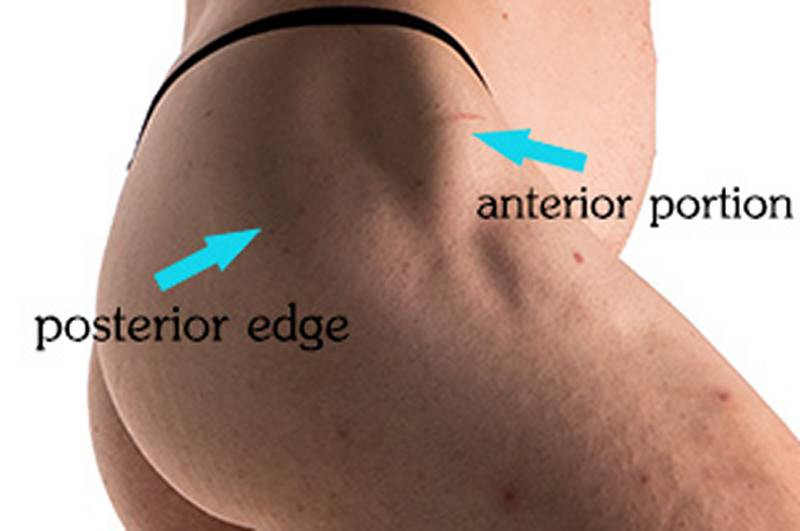 Landmarks of the gluteus medius