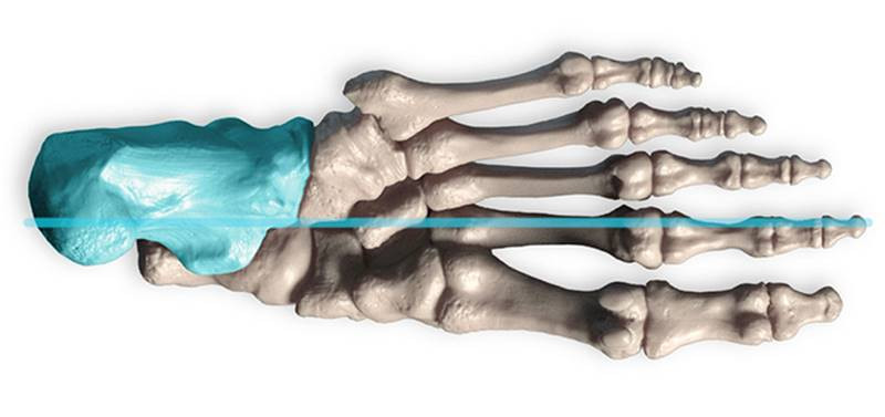 The Calcaneus is on the lateral side of the foot for load bearing