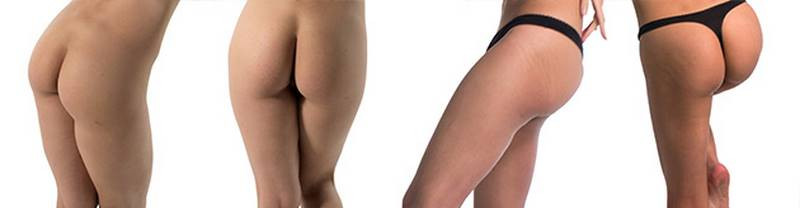Tensor Fasciae Latae in females, obscured by fat layer